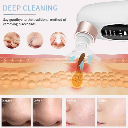 Blackhead Remover - Zero HUB